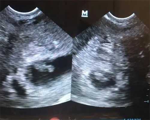 重庆捐卵盲捐多少钱 附重庆试管婴儿医院明细 ‘彩超孕囊怎么看男女’