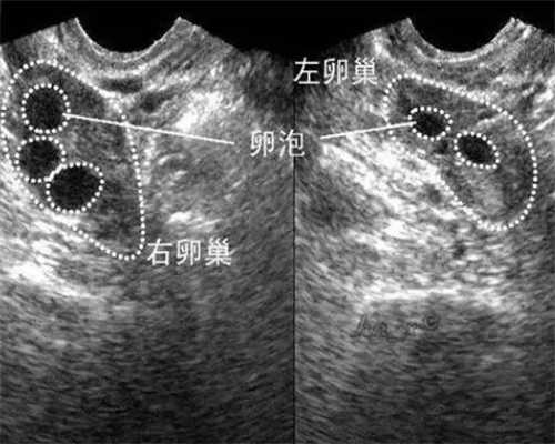 重庆借卵试管多少钱 重庆七星岗做试管婴儿有优惠吗? ‘女人做彩超下面图片’
